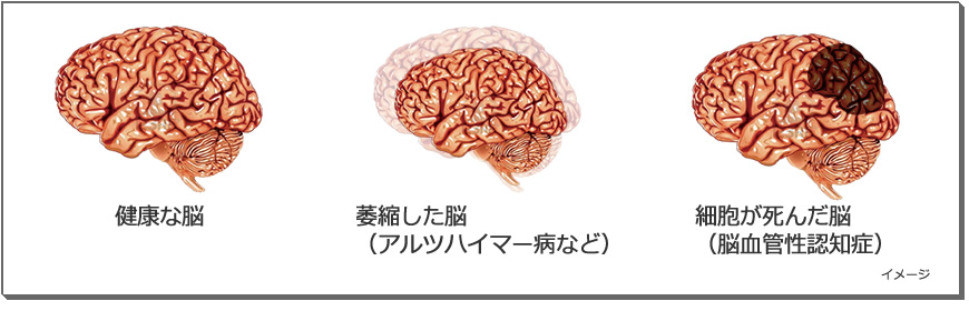 認知症・脳イメージ